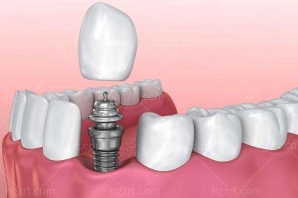 滁州种植牙价格