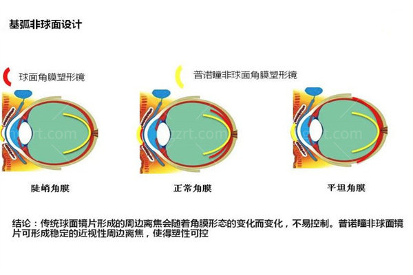 普诺瞳角膜塑形镜