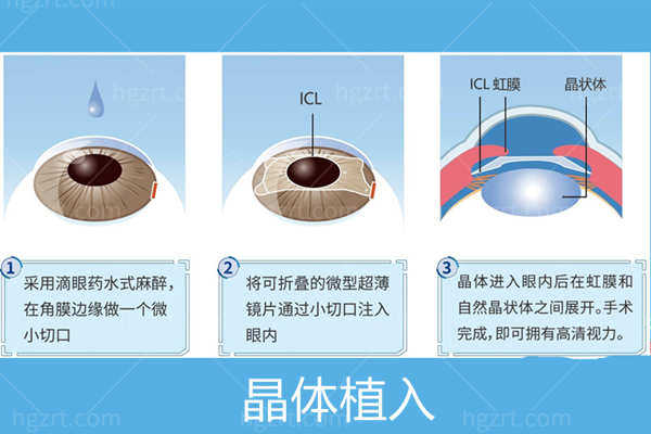 晶体植入近视眼手术
