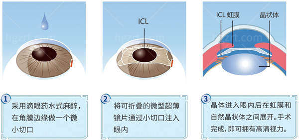 上海未来视界眼科医院价格表
