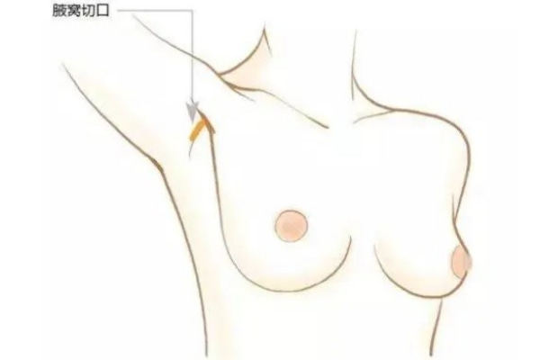 假体隆胸切口在什么位置比较好
