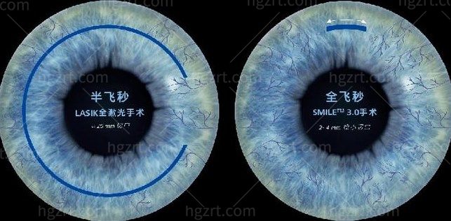 全飞秒半飞秒和晶体植入的区别