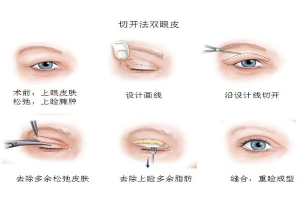 双眼皮手术
