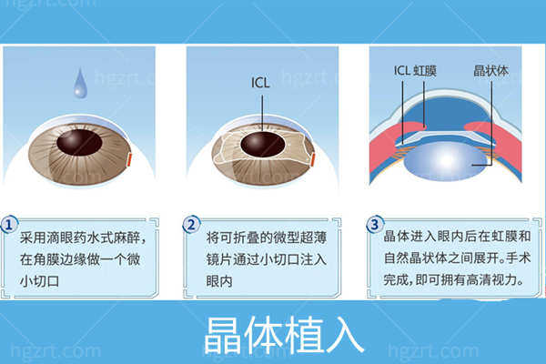 成都普瑞眼科晶体植入近视眼手术费用