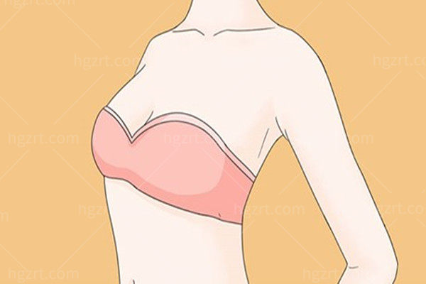 隆胸假体怎么选型号、尺寸