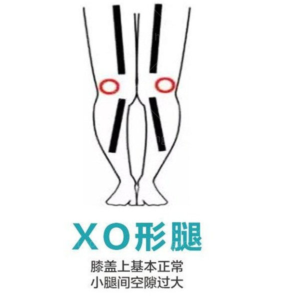 为什么女生多数是xo型腿