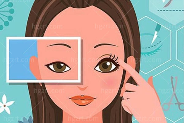 双眼皮经历过程分享