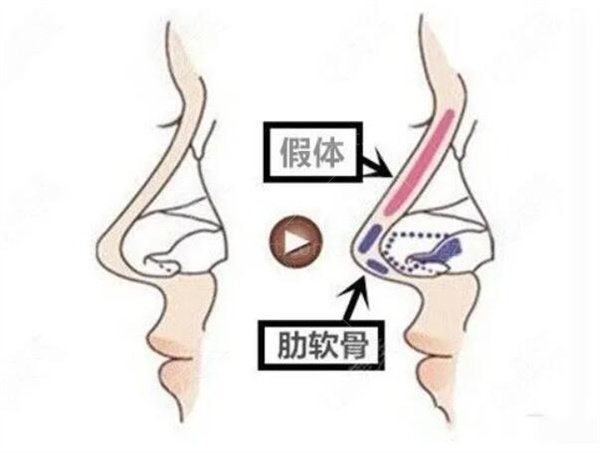 王琳医生隆鼻