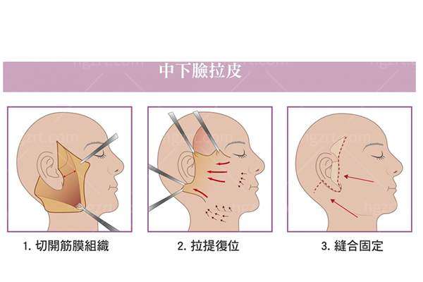 拉皮手术