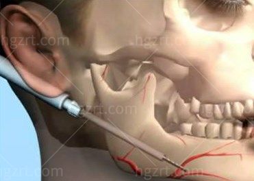 下颌角手术避开神经线多远可以做