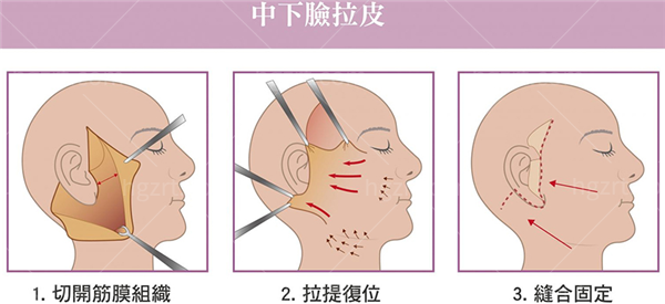 上海拉皮手术哪家医院好