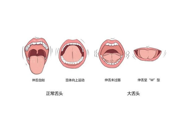 别再把舌头垫在牙齿中间了