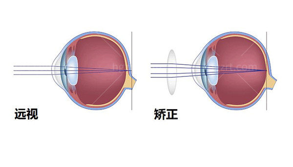 贵港爱眼眼科医院近视矫正