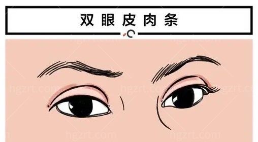 丁金萍双眼皮修复多少钱