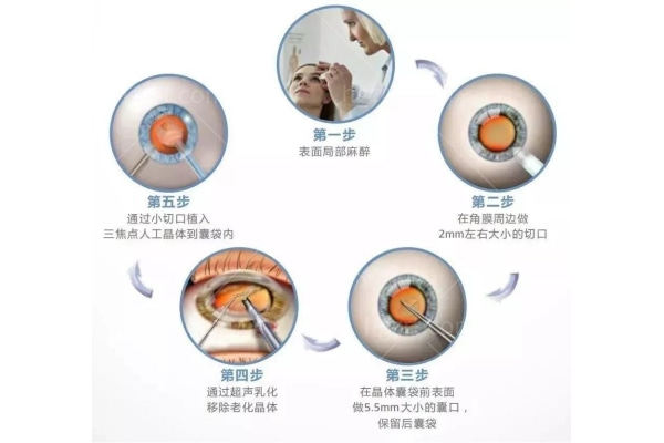 80岁有没有必要做白内障手术