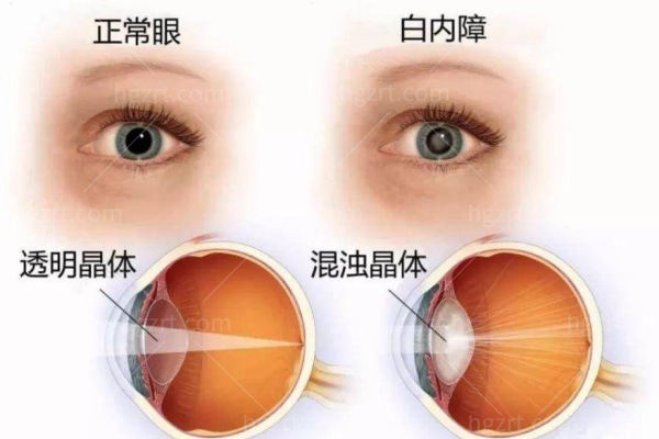 老人怎样申请免费白内障