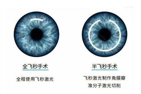 2023广州半飞秒近视矫正价格表