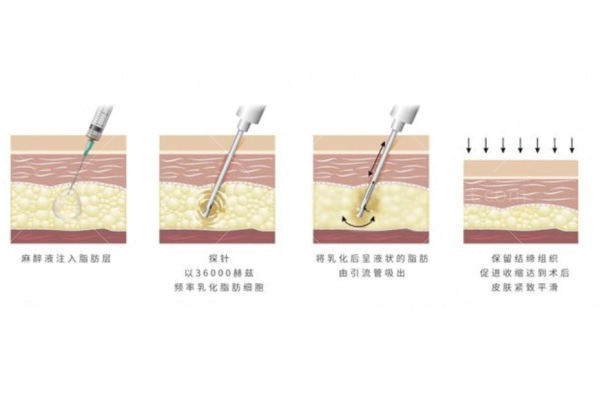 吸脂过程