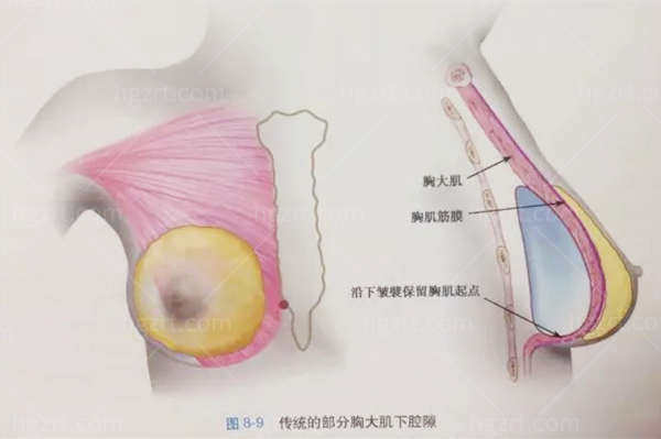 南京友谊医院隆胸收费价格表