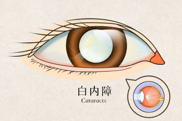 白内障手术晶体怎么选择