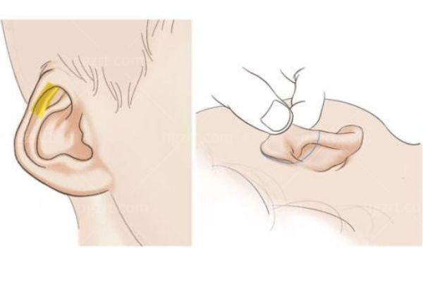 郑州市第二中医院好吗?密探说扩张皮瓣法外耳再造术是耳部缺陷的救星