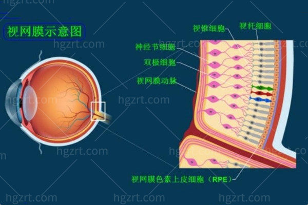 视网膜脱落前兆与症状有哪些表现