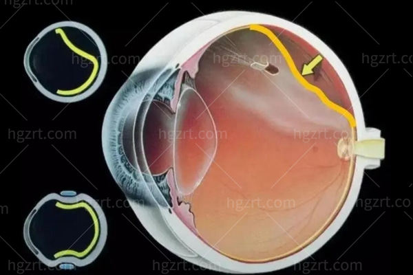 视网膜脱落前兆与症状有哪些表现