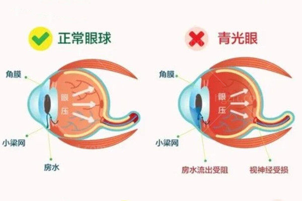 青光眼的早期症状和表现是什么