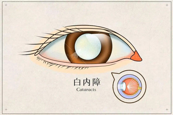 上海白内障眼科医院哪家好还能刷医 保