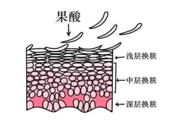 果酸焕肤的作用与功效