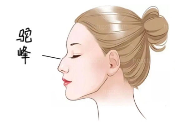驼峰鼻矫正手术多少钱 hold不住的驼峰鼻怎么矫正？