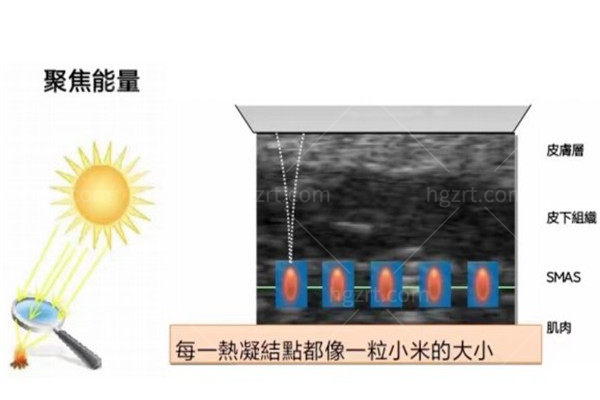 尖峰之星超声王的功能介绍