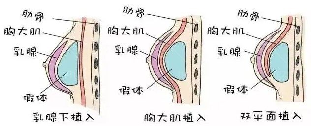 假体隆胸和自然胸手感一样吗