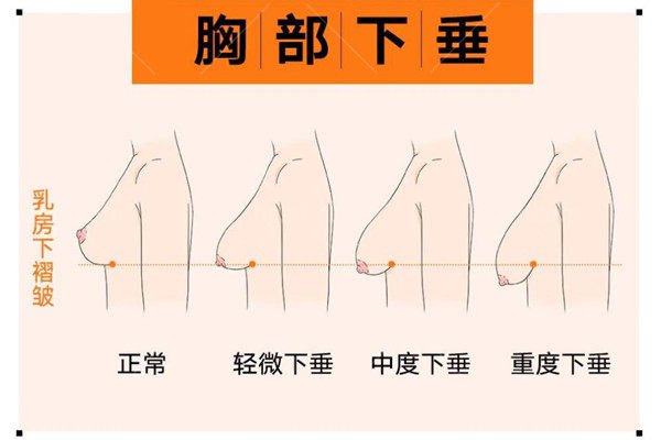 假体隆胸和悬吊术可以一起做吗