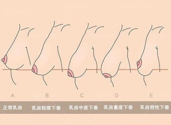 隆胸悬吊手术和假体隆胸还会下垂吗