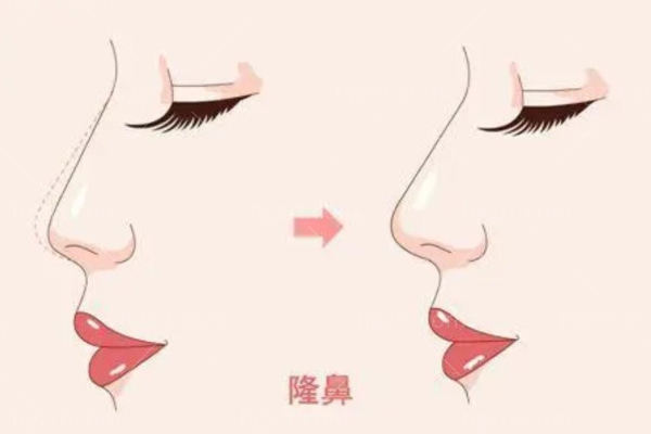 北京鼻整形医生排名榜前十名爆出！隆鼻鼻修复医生技术很重要