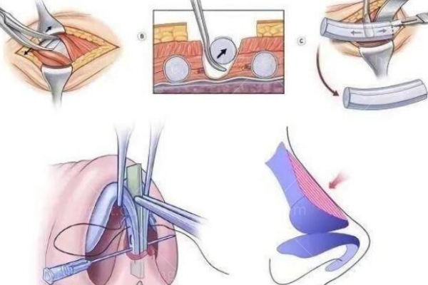 自体肋软骨隆鼻知识小科普？自体肋软骨隆鼻维持时间价格等干货满满