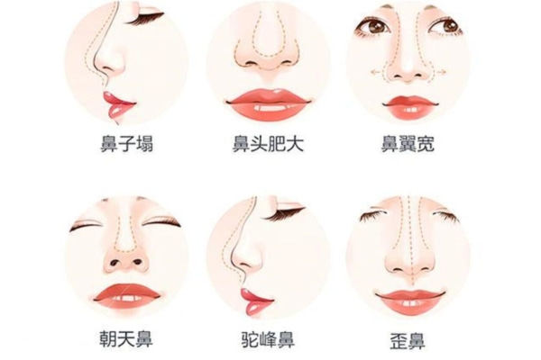 解密什么是曼特波隆鼻？原理/优缺点/适应人群/价格等这里都有