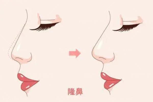 解密什么是曼特波隆鼻？原理/优缺点/适应人群/价格等这里都有