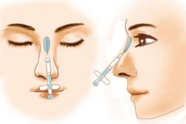 广州鼻整形医生排名榜前十名爆出:来看看谁鼻整形鼻修复技术好