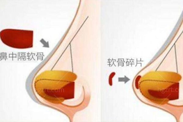 自体软骨垫鼻子从哪里取骨头