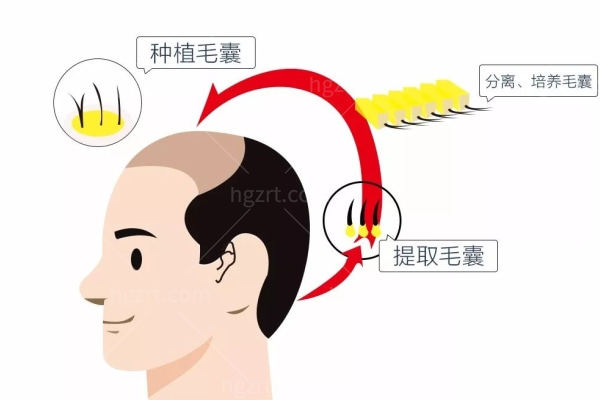 国内微针植发医院排名 良心测评这几家技术口碑不踩坑