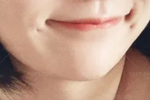 做梨涡手术的医院有哪些？想要拥有妩媚动人笑容全靠这几家！