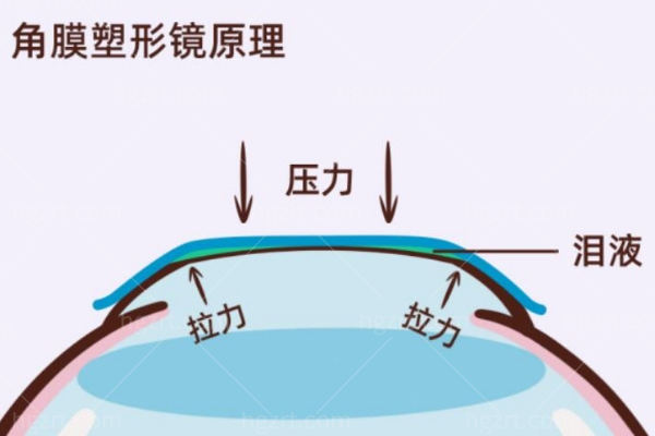 角膜塑形镜真的可以治疗近视吗