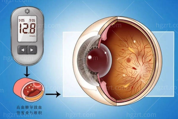 糖尿病视网膜病变，糖网