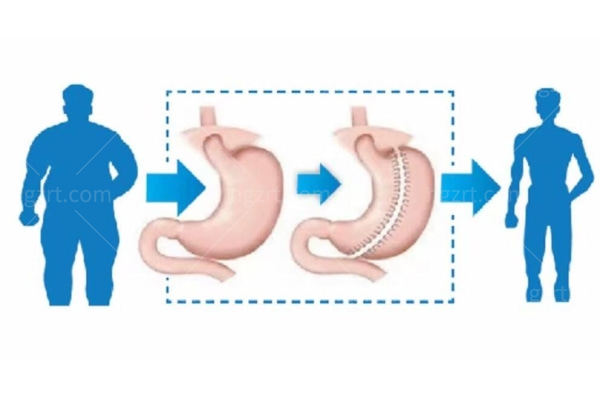 袖状胃切除手术是什么意思