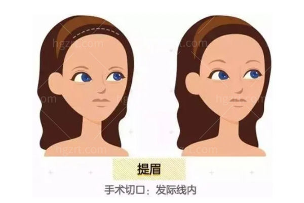 韩国提眉手术医院排名榜单 世美/BIO提眉技术靠谱实力强均均上榜