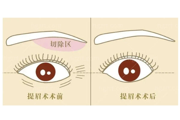 韩国提眉手术医院排名榜单 世美/BIO提眉技术靠谱实力强均均上榜