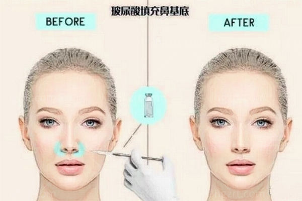 垫鼻基底用什么材料好？另看垫鼻基底多久才能**自然