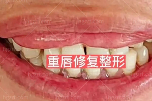 重唇修复术是什么?它的手术方式是什么哪些医院可以做？